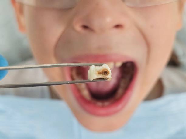 Best Emergency Wisdom Tooth Extraction in Bowling Green, MO